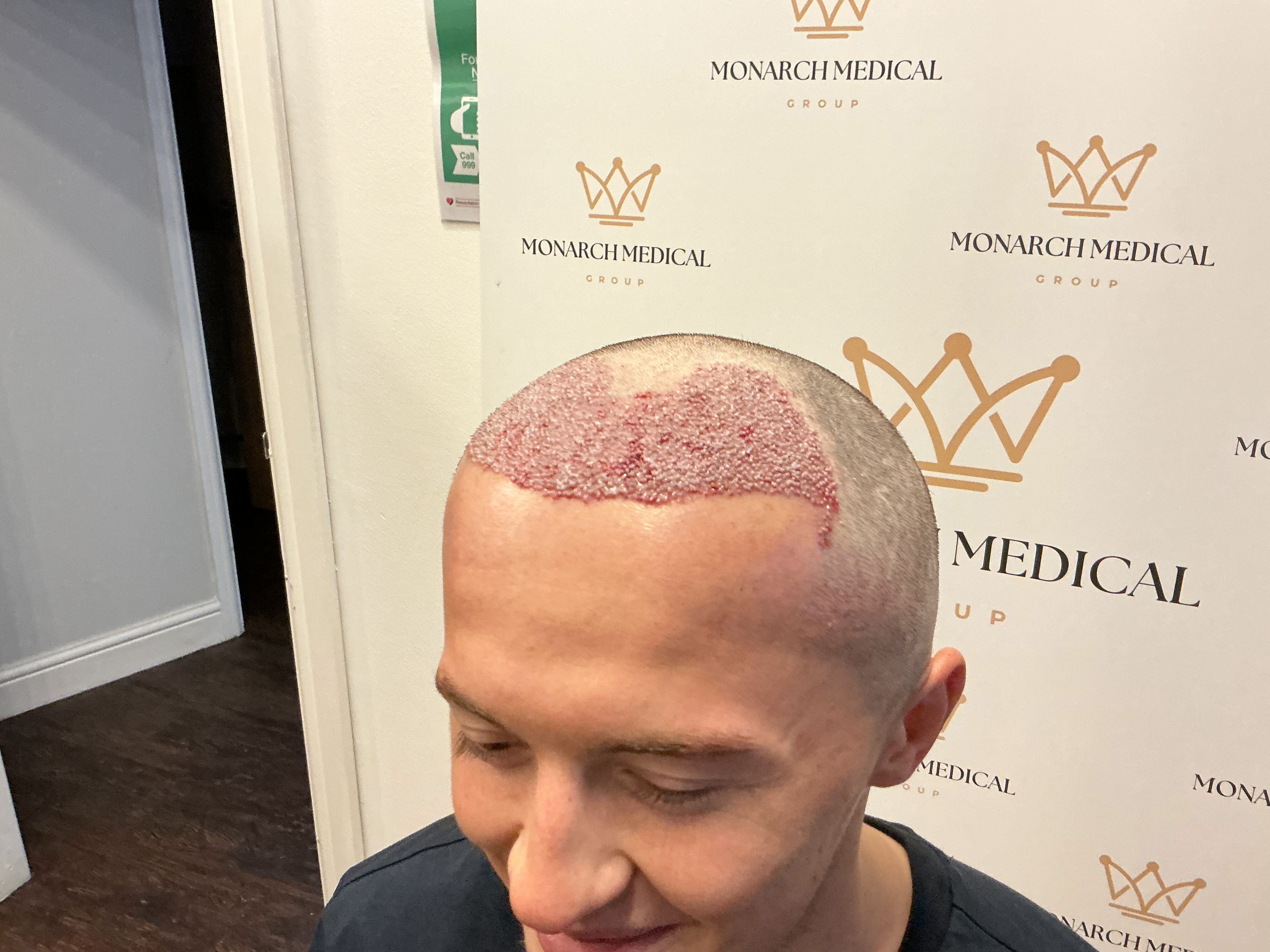 Advanced hairline recession — result photo 8
